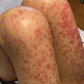 Well-defined papules coalescing into plaques on the anterior aspects of the thighs